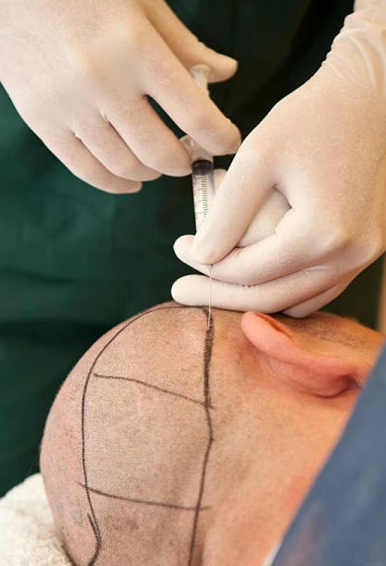 clínica de transplante capilar em mulheres