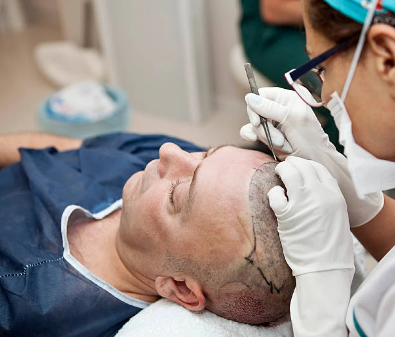 clínica de transplante capilar fio a fio