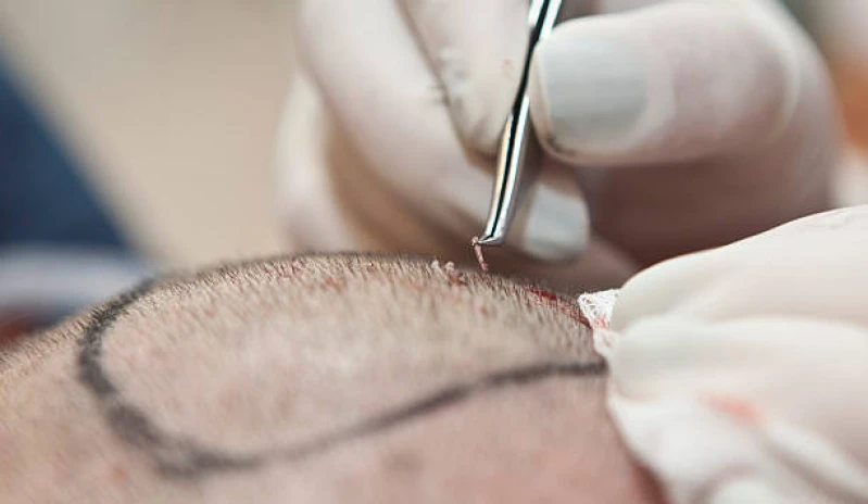 clínica de tratamento capilar para queda de cabelo