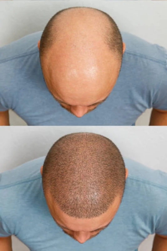 clínica de tratamento para crescimento de cabelo joinville