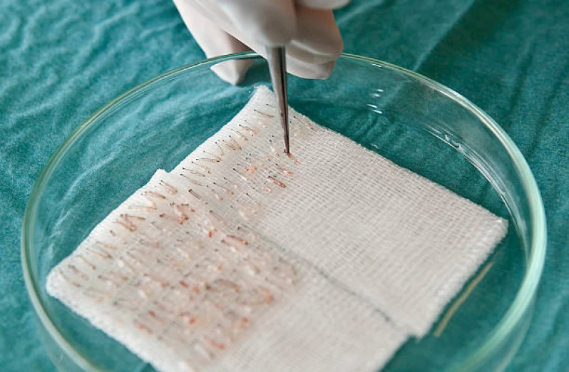 clínicas de transplante capilar