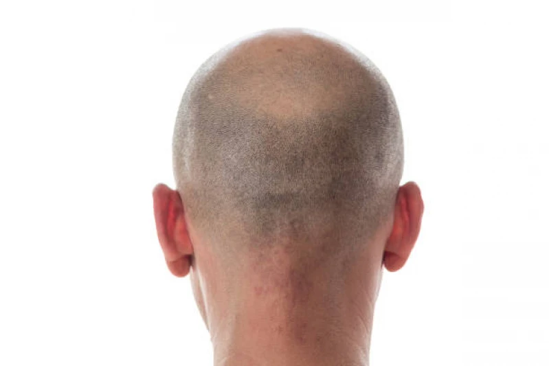 implante cabelo masculino