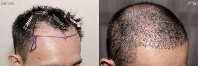 implante capilar alopecia androgenética