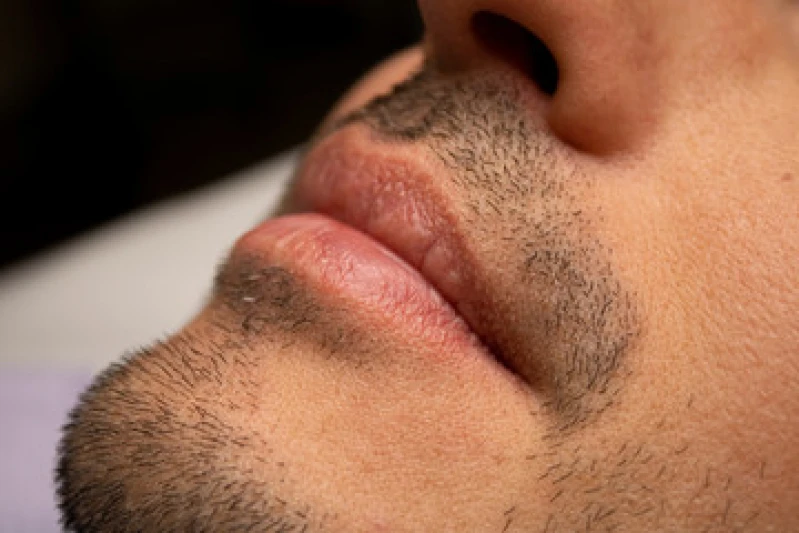 implante capilar de barba