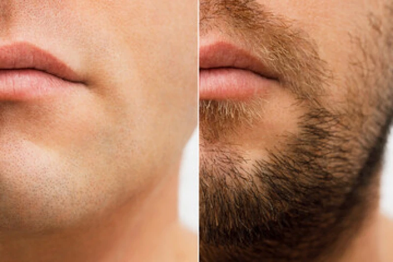 implante capilar para barba