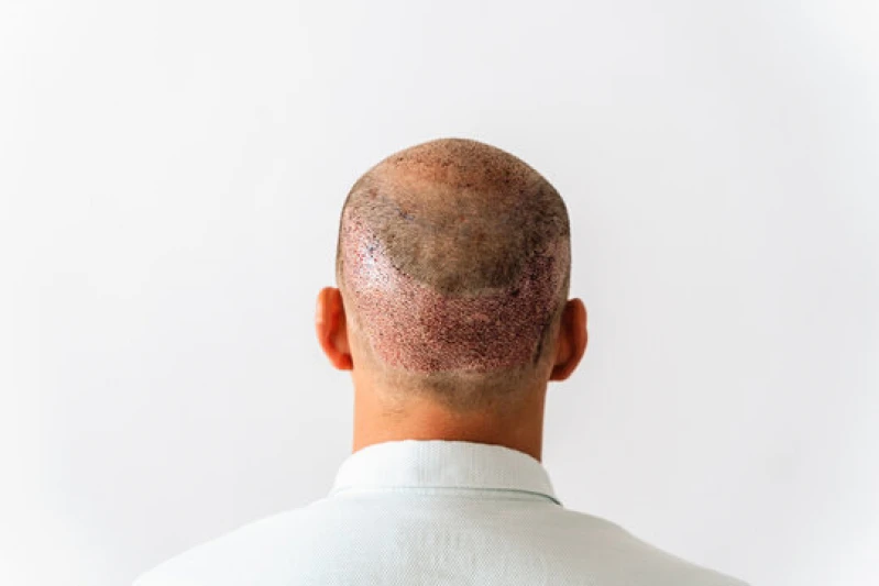 implante de cabelo fio a fio