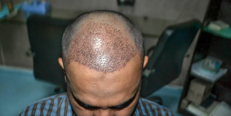 implante de cabelo para mulher