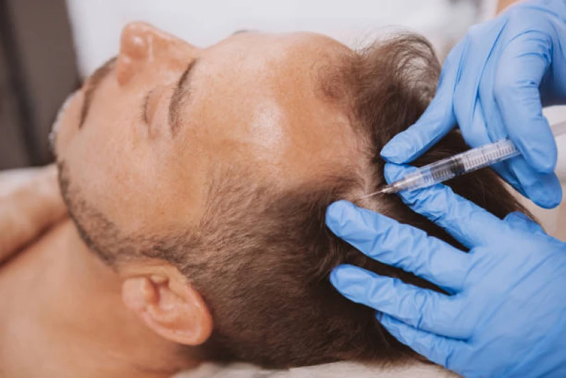 implante para cabelo
