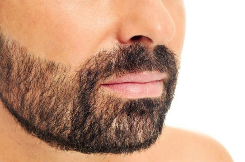 implantes de barba