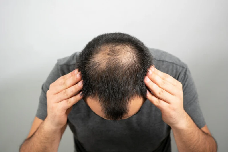 implantes de cabelo
