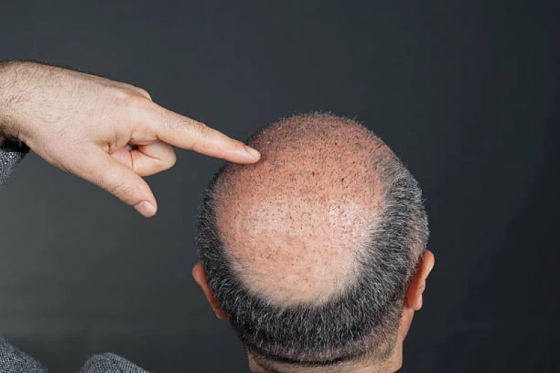implantes para cabelo