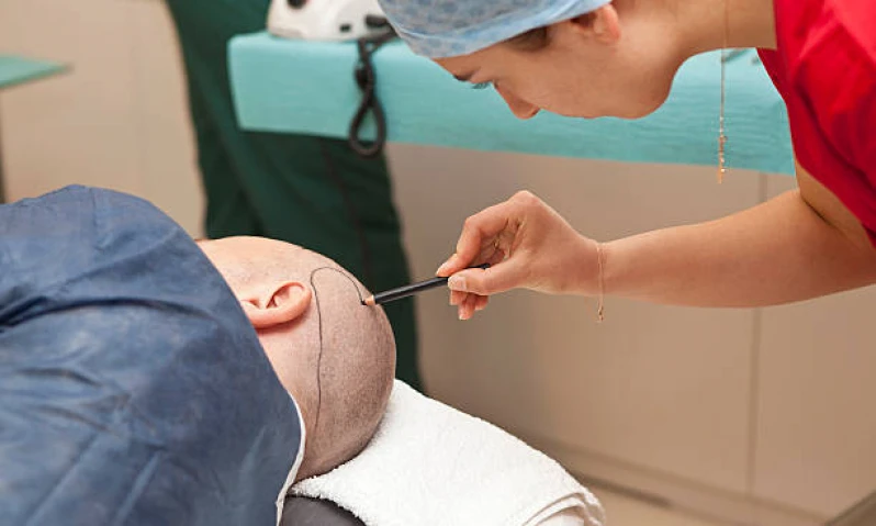 preenchimento capilar para barba