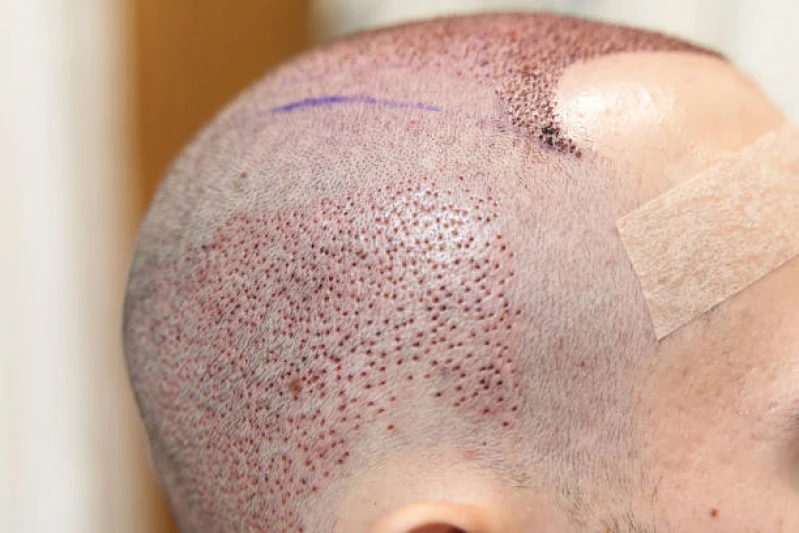 transplante cabelo masculino