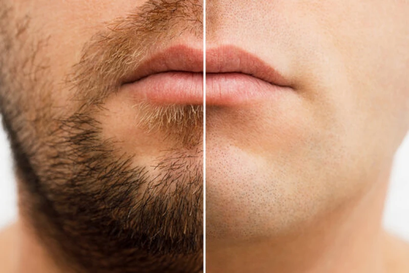 transplante capilar na barba joinville