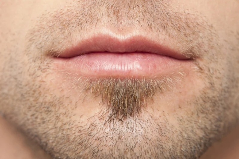 transplante capilar para barba