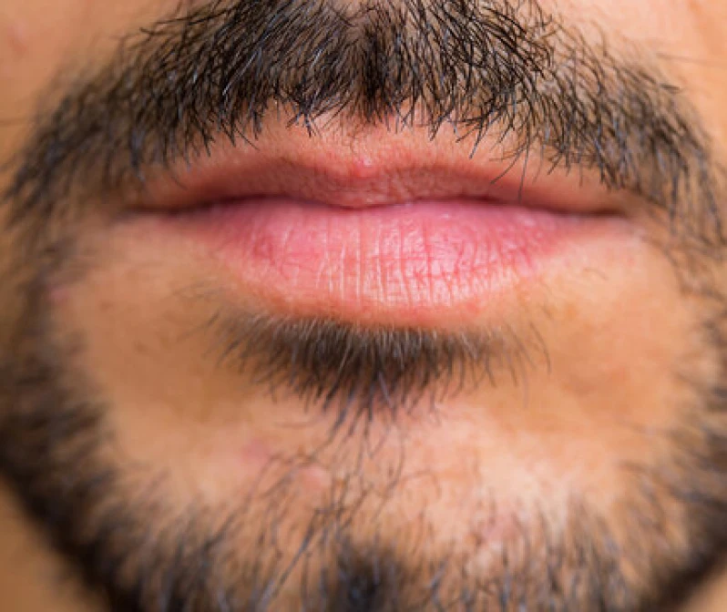 transplante de barba