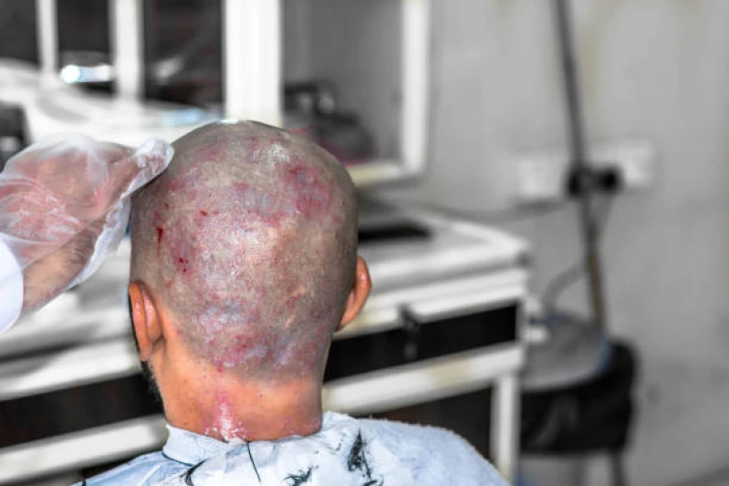 transplante de cabelo fue