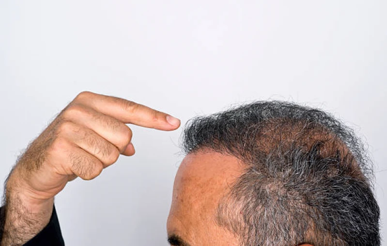 transplante de cabelo masculino