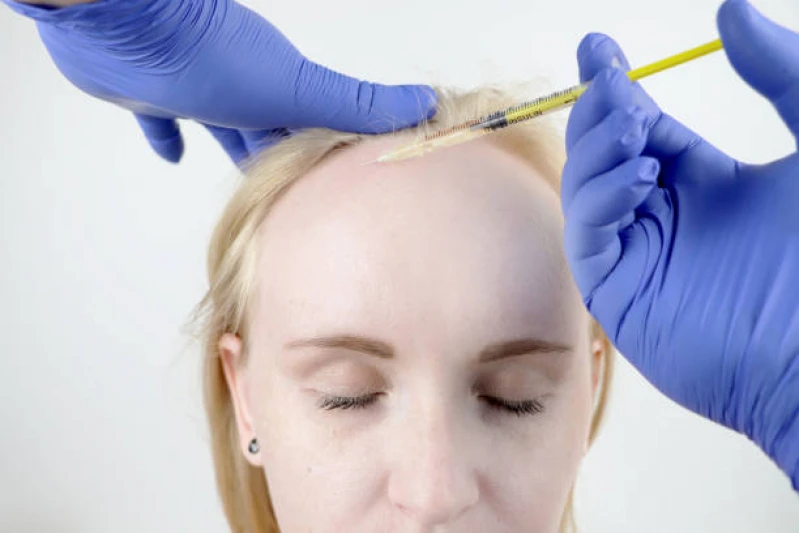 transplante de cabelo para mulheres
