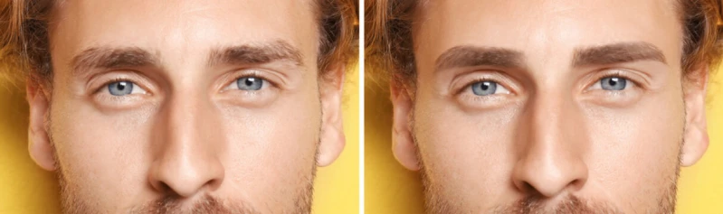 transplante de sobrancelha masculina