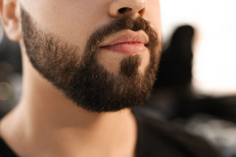 transplante na barba