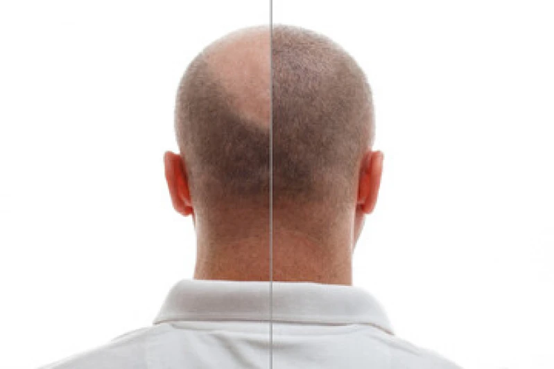transplante para crescer o cabelo