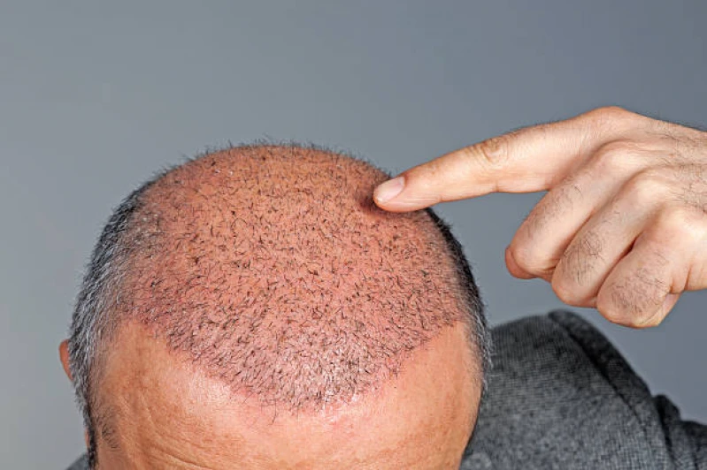 tratamento com microagulhamento para calvície