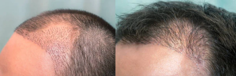 tratamento de calvície masculina