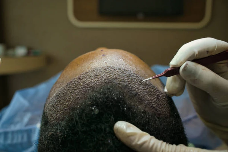 tratamento de queda de cabelo