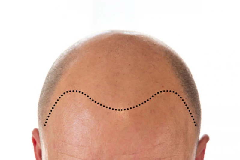 tratamento para queda de cabelo