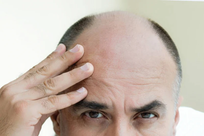 tratamentos para queda de cabelo